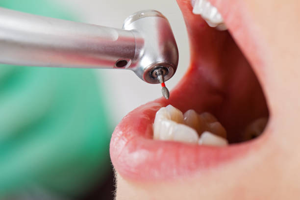 Best Emergency Tooth Extraction in Banks Springs, LA
